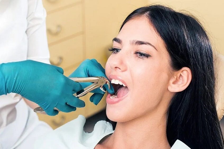 TEETH EXTRACTIONS